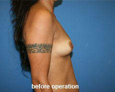 plastic-surgery-breast-augmentation